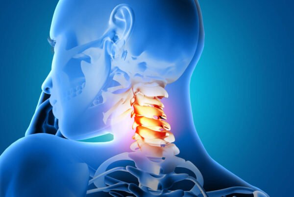 Schema di un'ernia cervicale che comprime un nervo